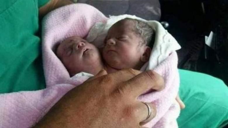 نوزادی که با ۲ سر به دنیا آمد/تصاویر