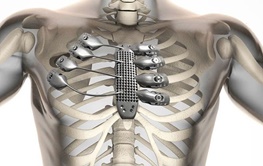 ساخت دنده و جناغ سینه یک بیمار سرطانی با پرینتر سه‌بعدی