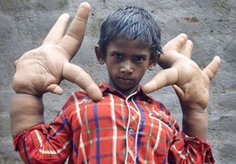 جراحی دستهای غول‌آسای پسر هندی