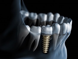 ایمپلنت دندان چطور صورت می‌گیرد؟/همه مراحل در یک تصویر متحرک