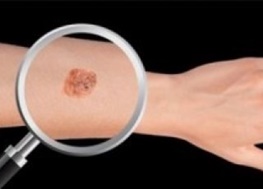 درمان کشنده‎ترین نوع سرطان پوست با روش جدید پزشکان/معالجه برای ملانوما