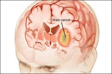 تشخیص غیرتهاجمی سرطان مغز  ظرف 30 دقیقه