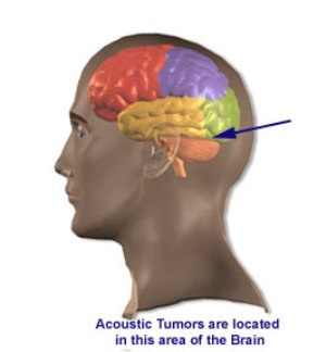 آسپرین رشد تومور گوش را متوقف می‌کند
