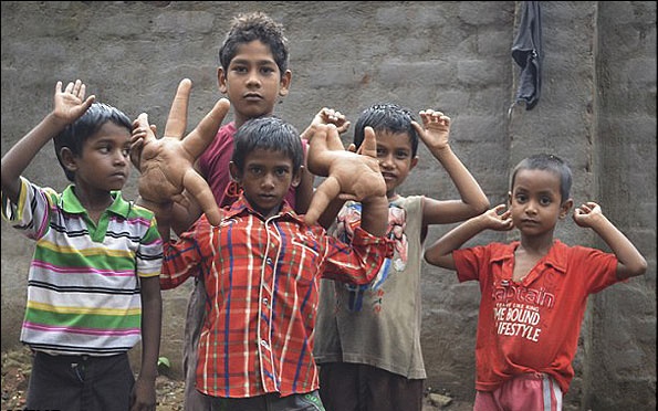 کودک هندی با دستان غول پیکر