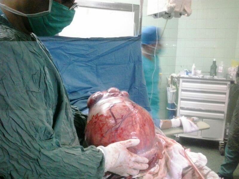 خارج کردن توده 15 کیلوگرمی از رحم بیمار سلماسی