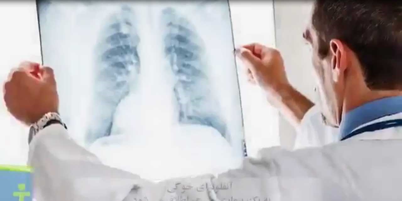 علایم آنفلوانزای خوکی را ببینید