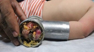 چرخ گوشت دست نوزاد را بلعید