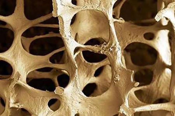 کشف سرنخ های جدید برای درمان پوکی استخوان