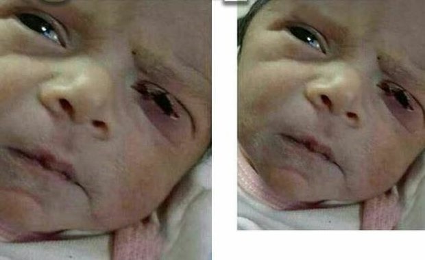 بریدگی پلک نوزاد در نطنز به تائید رسید