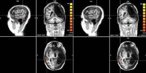 امکان کپی و پیست اطلاعات از نیمکره چپ به راست مغز در وضعیت آسیب وخیم