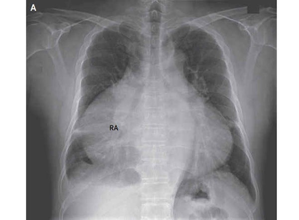 قلبی غول‌پیکر را در سینه مرد ۵۷ ساله ببینید/اشغال  82 درصد از فضای عرضی قفسه سینه