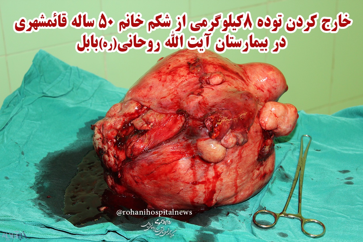 خارج کردن  توده 8 کیلوگرمی از شکم خانم  قائمشهری در بیمارستان آیت‌الله روحانی(ره)
