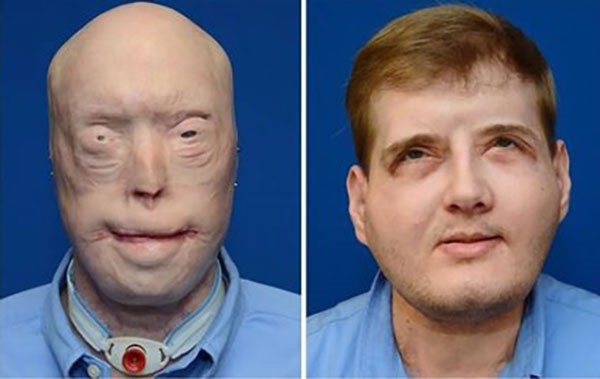 نتیجه جراحی بی‌سابقه پیوند صورت را ببینید/یک سال پس از عمل پیچیده‌ پزشکی 