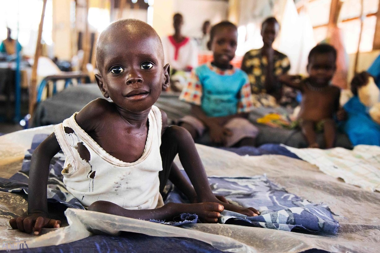 عکس| نگاه تاثیرگذار کودک سودانی که از سوءتغذیه رنج می‌برد