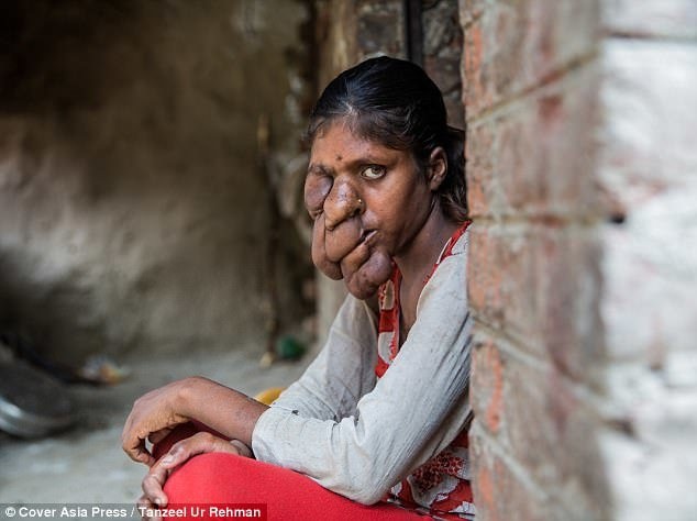 ظاهر عجیب دختر هندی به دلیل بیماری ژنتیکی/ عکس 