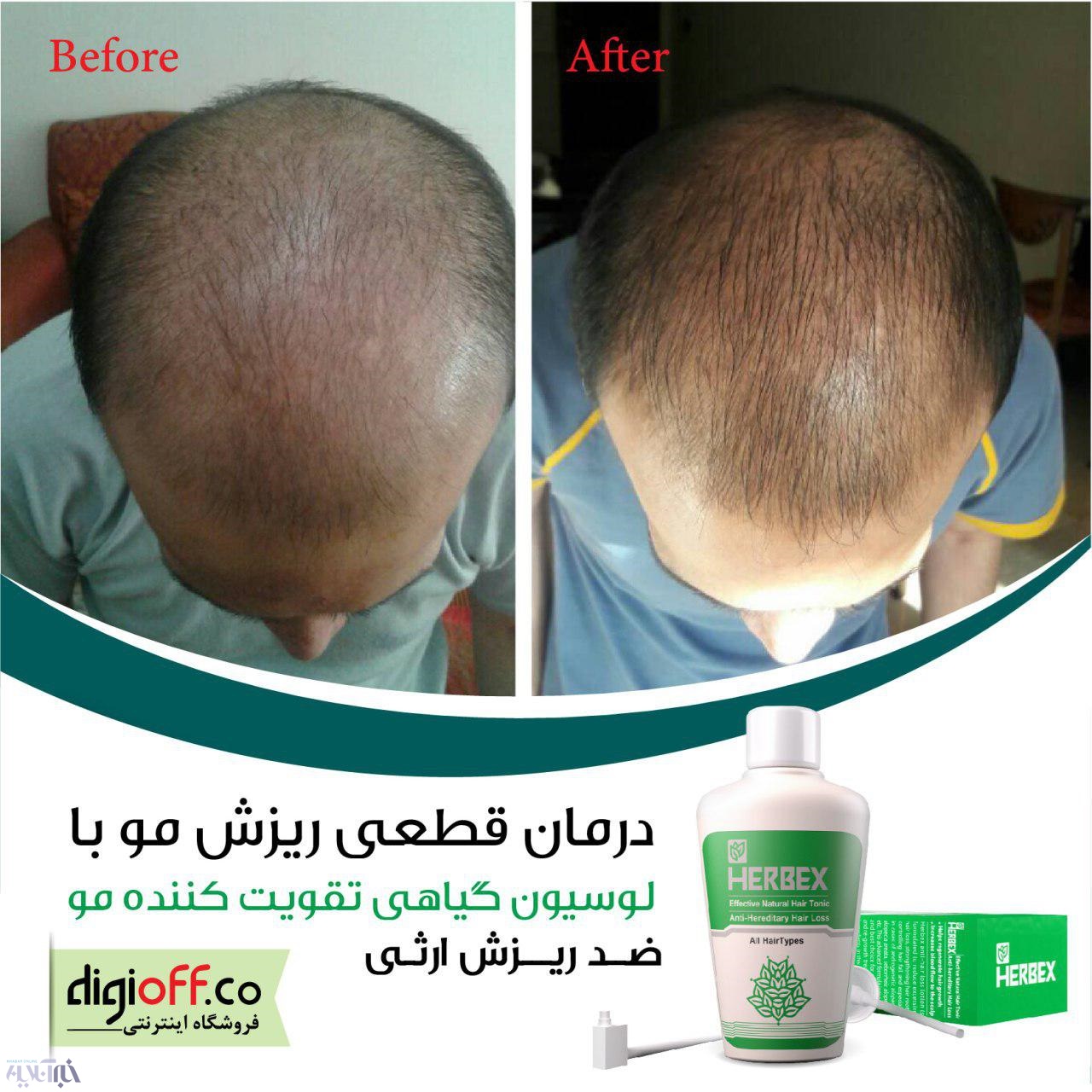 لوسیون ضدریزش هربکس راهکار رفع ریزش و رشد مجدد مو