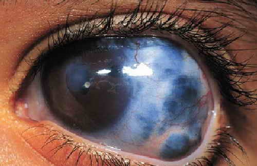 دومین عامل نابینایی در جهان را بشناسید!/ راهکارهای مهم برای مقابله
