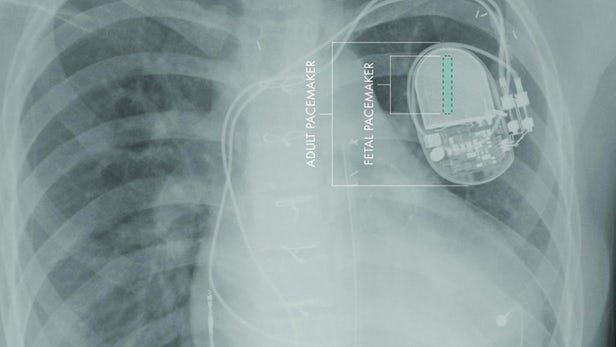 دستگاه مینیاتوری برای کنترل ریتم تپش قلب جنین