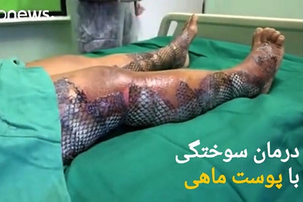 فیلم | درمان سوختگی‌های شدید با پوست یک نوع ماهی