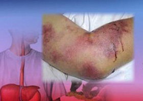 تب کنگو جان یک هرمزگانی را گرفت/ شناسایی ۱۰ مورد مشکوک در یزد