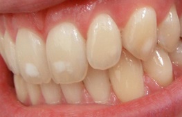 دلیل لکه‌های سفید روی دندان چیست؟ / راه‌های برطرف کردن لکه‌های سفید از دندان