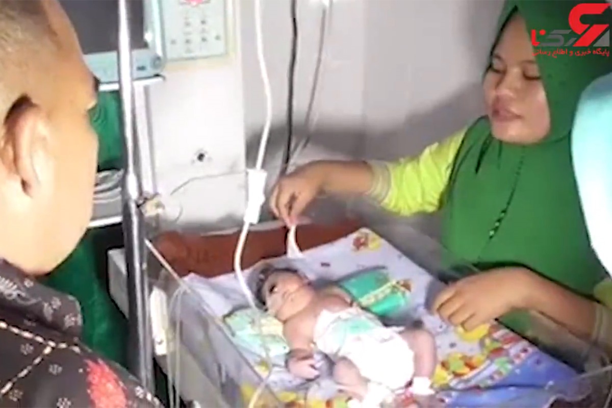 فیلم | وحشت پزشکان از تولد نوزاد تک چشم در اندونزی (۱۶+)
